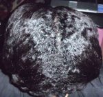 Texlax Hair New Growth | 11.5 Weeks Post Texlax